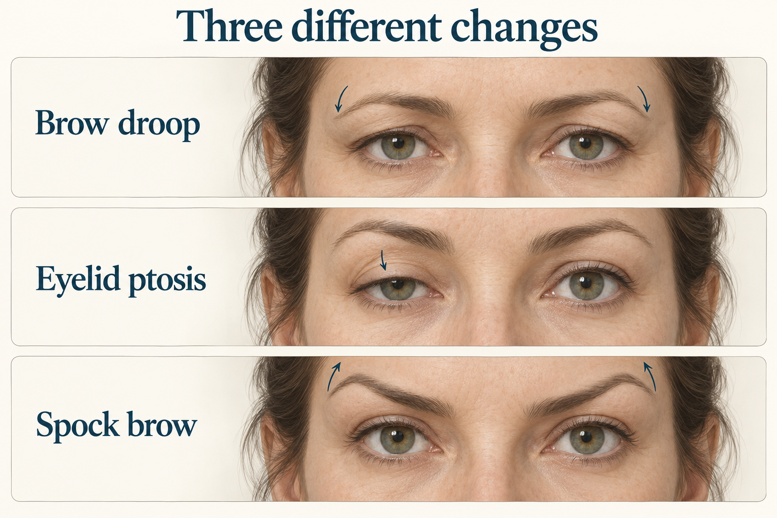 Three illustrated patterns: lowered brows, a drooping upper eyelid and peaked outer brows.