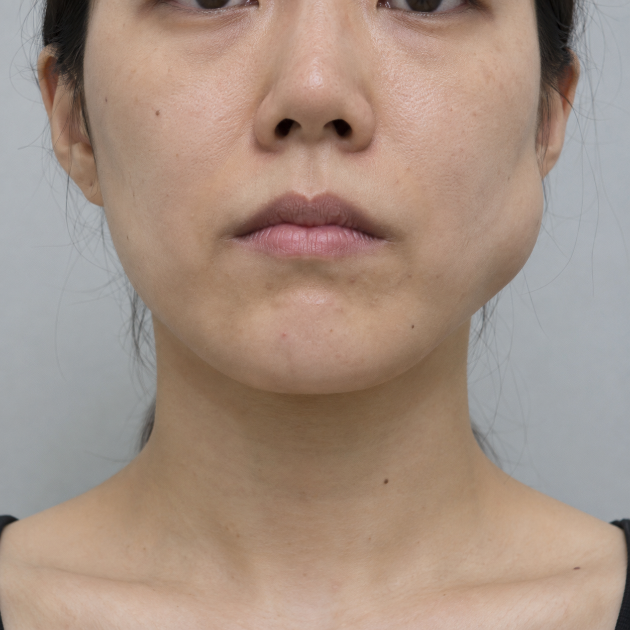 Illustrative example of a localized bulge over one masseter while clenching.