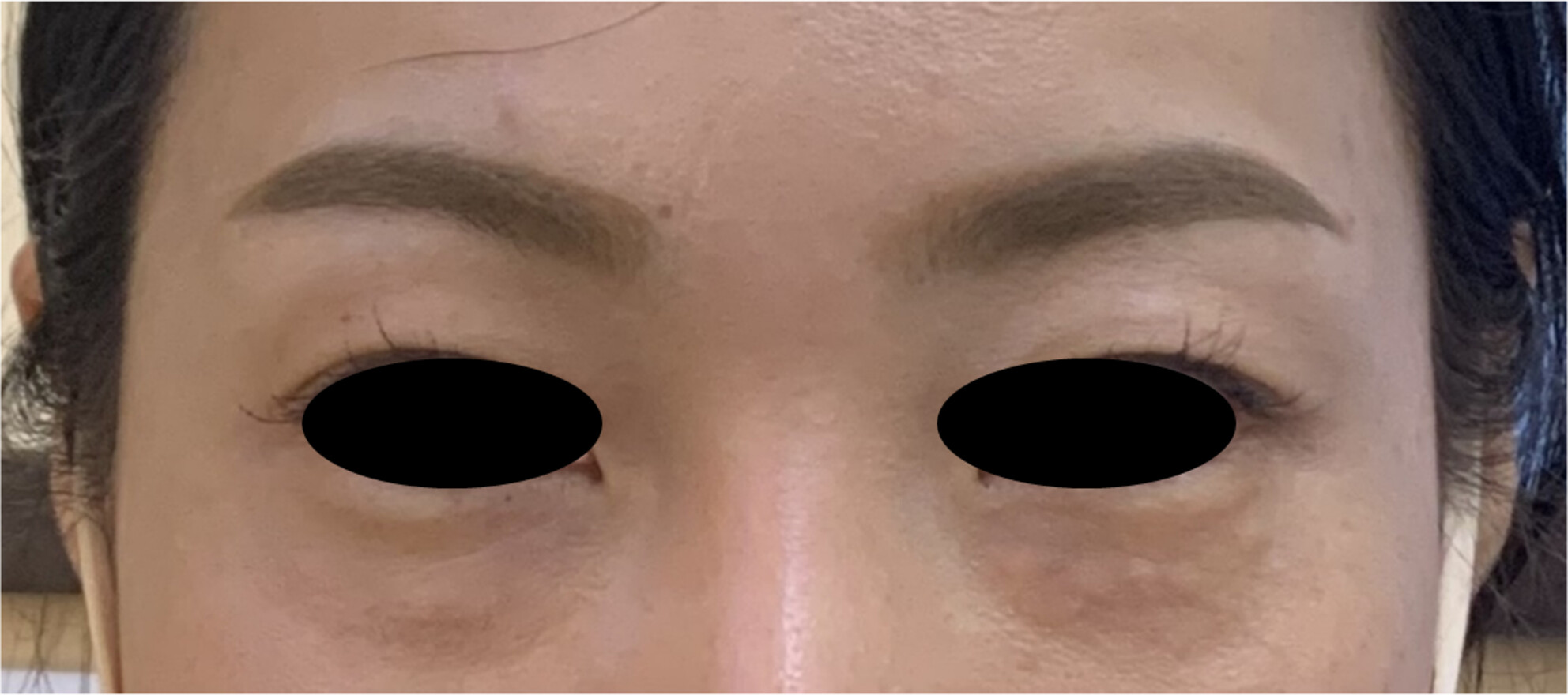 Published case photograph of visible tear-trough nodules three weeks after Juvelook Volume injection