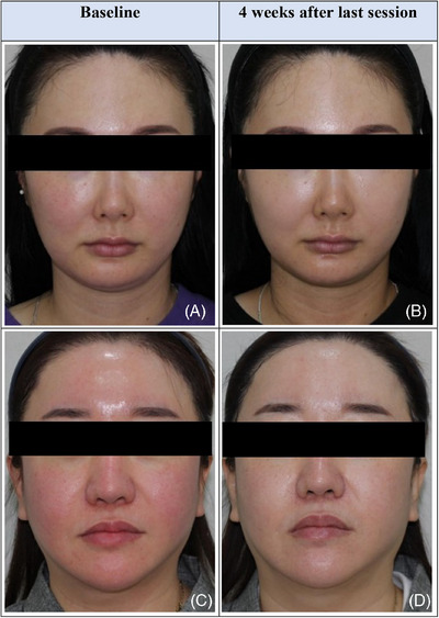 Published facial redness case photographs before a PN, hyaluronic acid and lidocaine mixture and four weeks after the third session