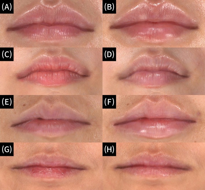 Published study photographs comparing lip appearance before treatment and three weeks after the third Rejuran session