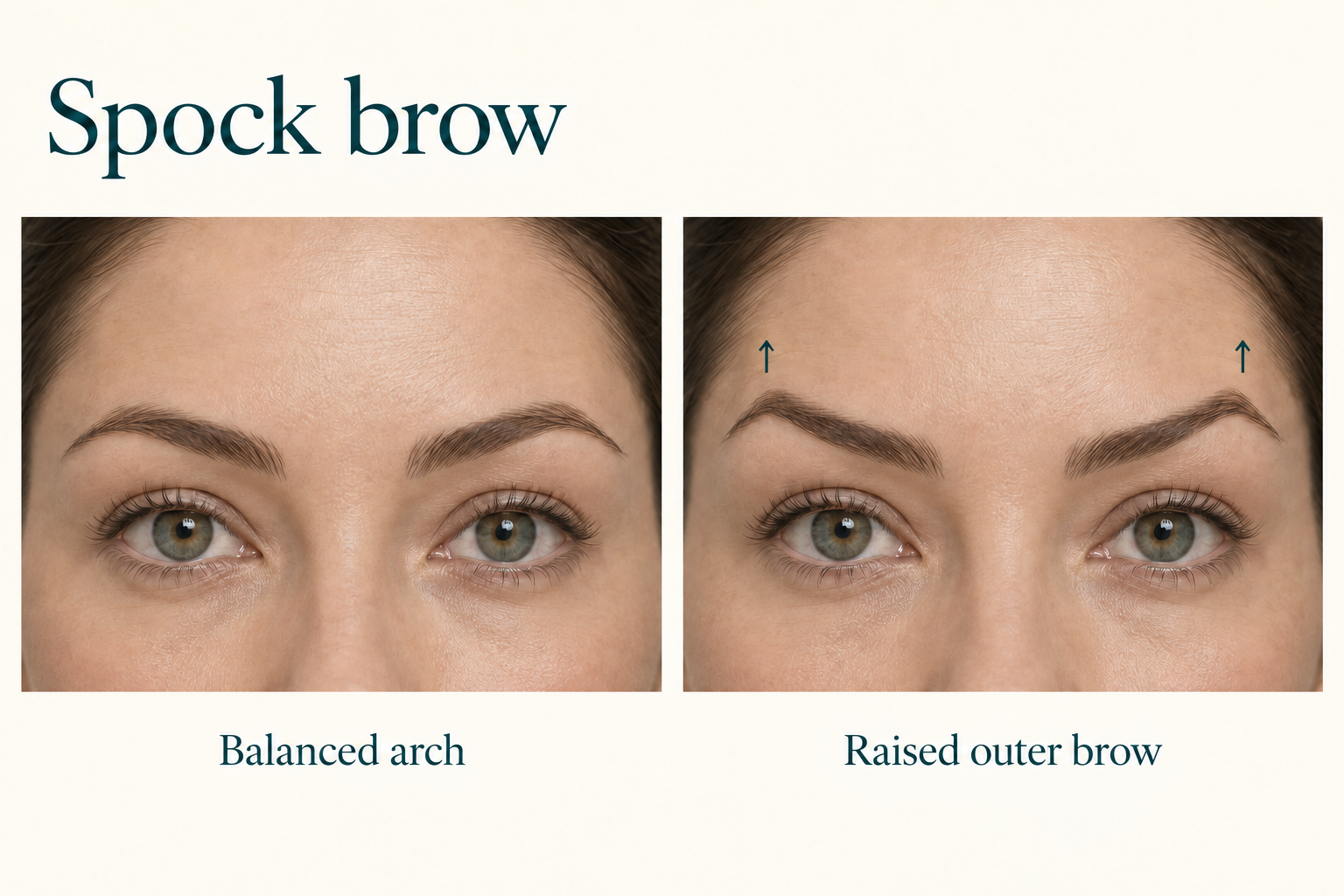 Conceptual comparison of a balanced eyebrow arch and a Spock brow with elevated outer eyebrow peaks.